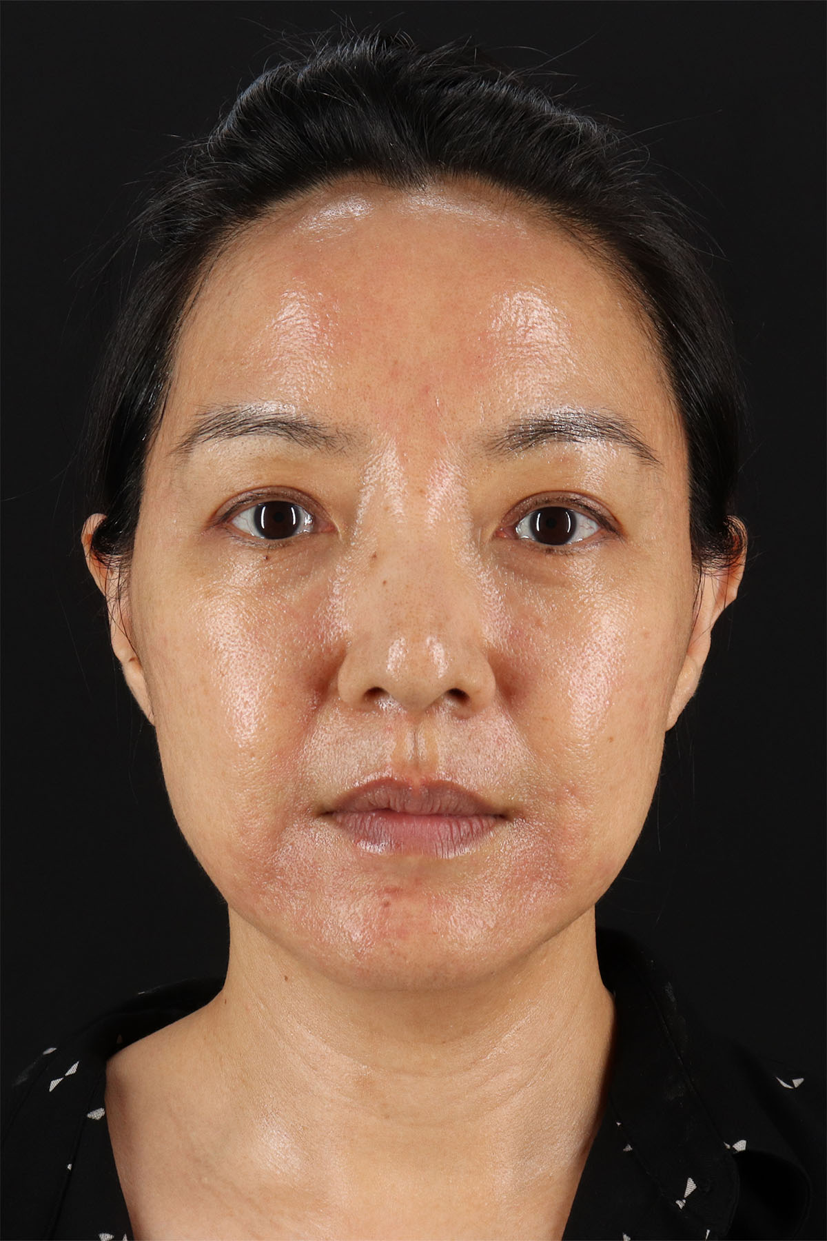 CO2 Laser Before & After Patient #11059