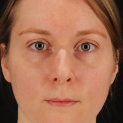 Rhinoplasty Before & After Patient #12238