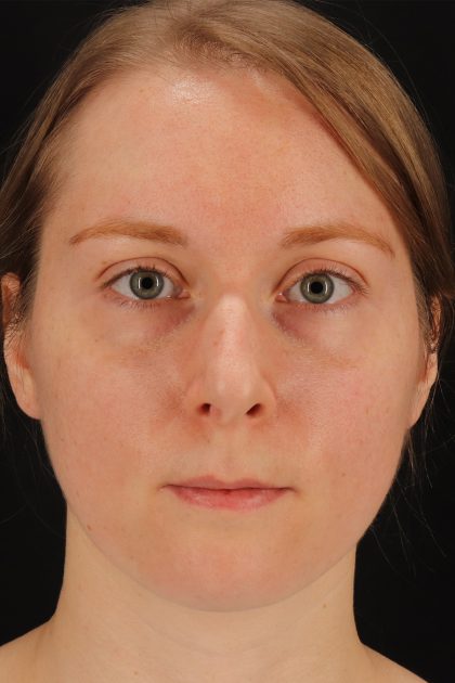 Rhinoplasty Before & After Patient #12238