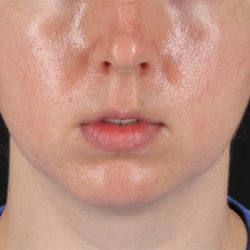 Chin Implant Before & After Patient #13761
