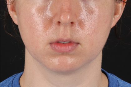 Chin Implant Before & After Patient #13761