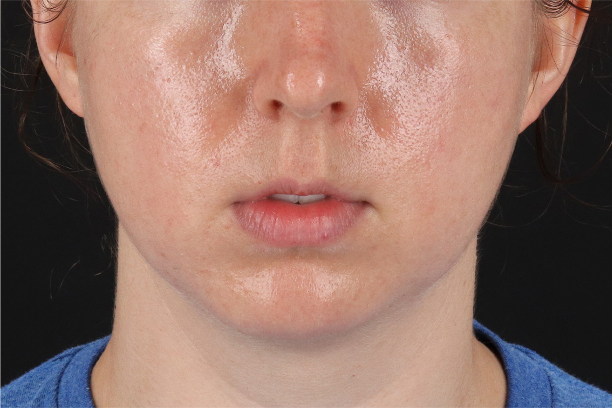 Chin Implant Before & After Patient #13761