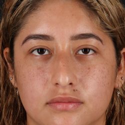 Rhinoplasty Before & After Patient #12491