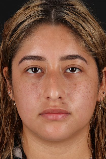 Rhinoplasty Before & After Patient #12491