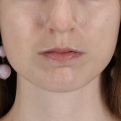 Buccal Fat Pad Before & After Patient #14025