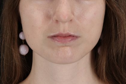 Buccal Fat Pad Before & After Patient #14025