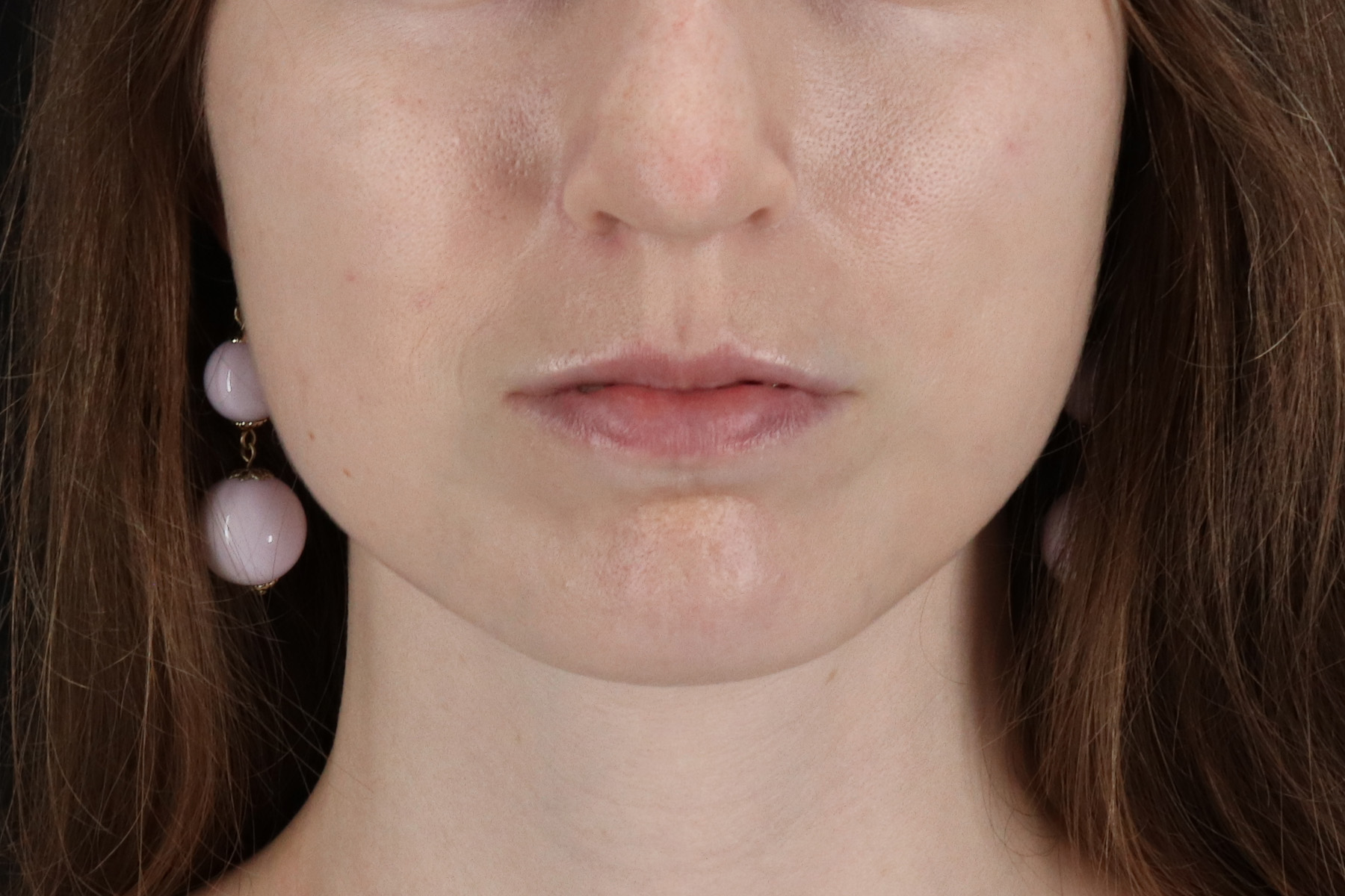 Buccal Fat Pad Before & After Patient #14025