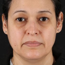 Rhinoplasty Before & After Patient #12205