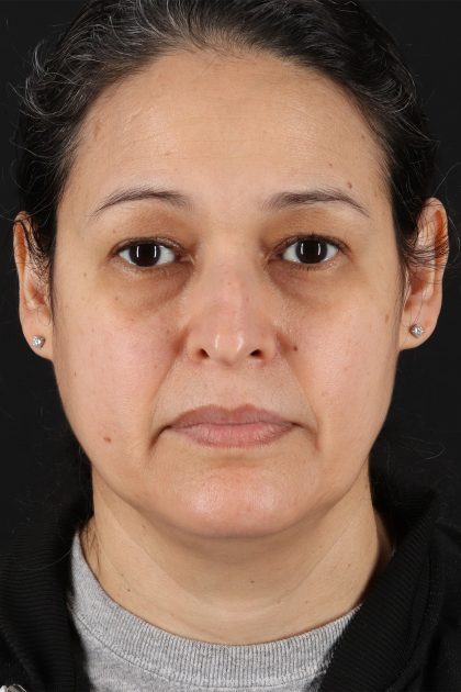 Upper Blepharoplasty Before & After Patient #12018
