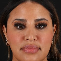 Rhinoplasty Before & After Patient #12183