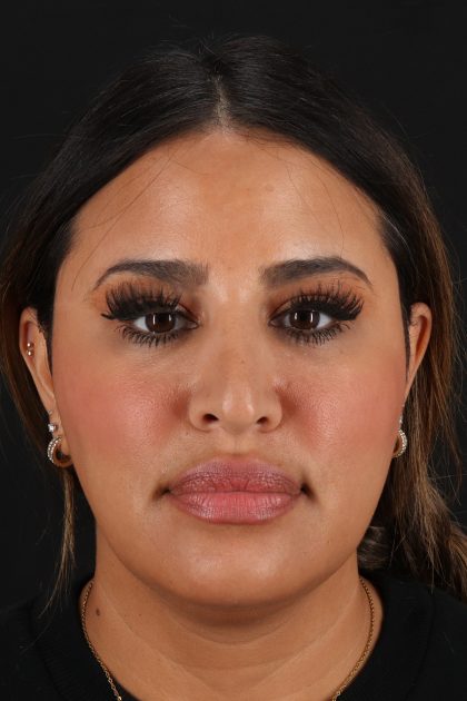 Rhinoplasty Before & After Patient #12183