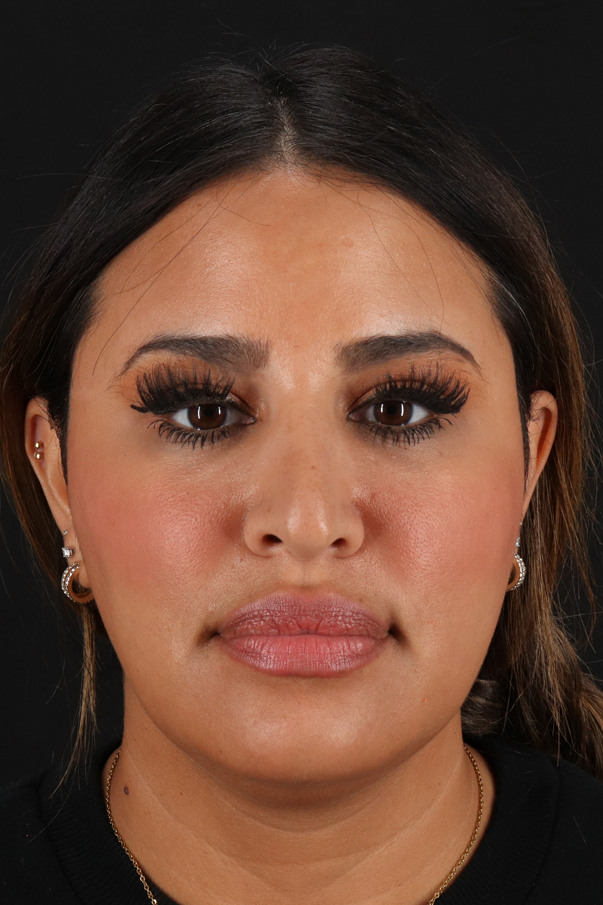Rhinoplasty Before & After Patient #12183