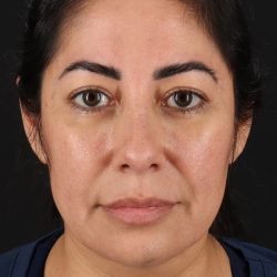 Buccal Fat Pad Before & After Patient #14014