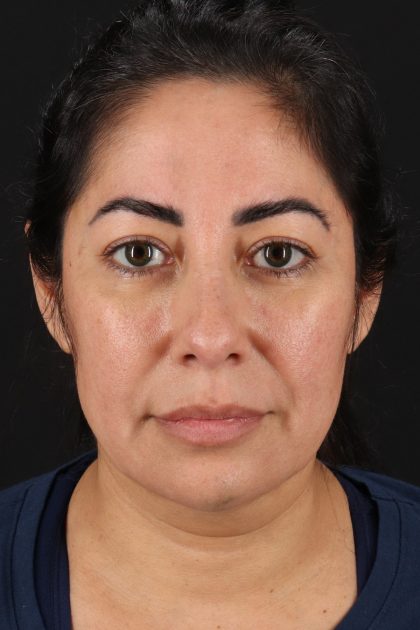 Buccal Fat Pad Before & After Patient #14014