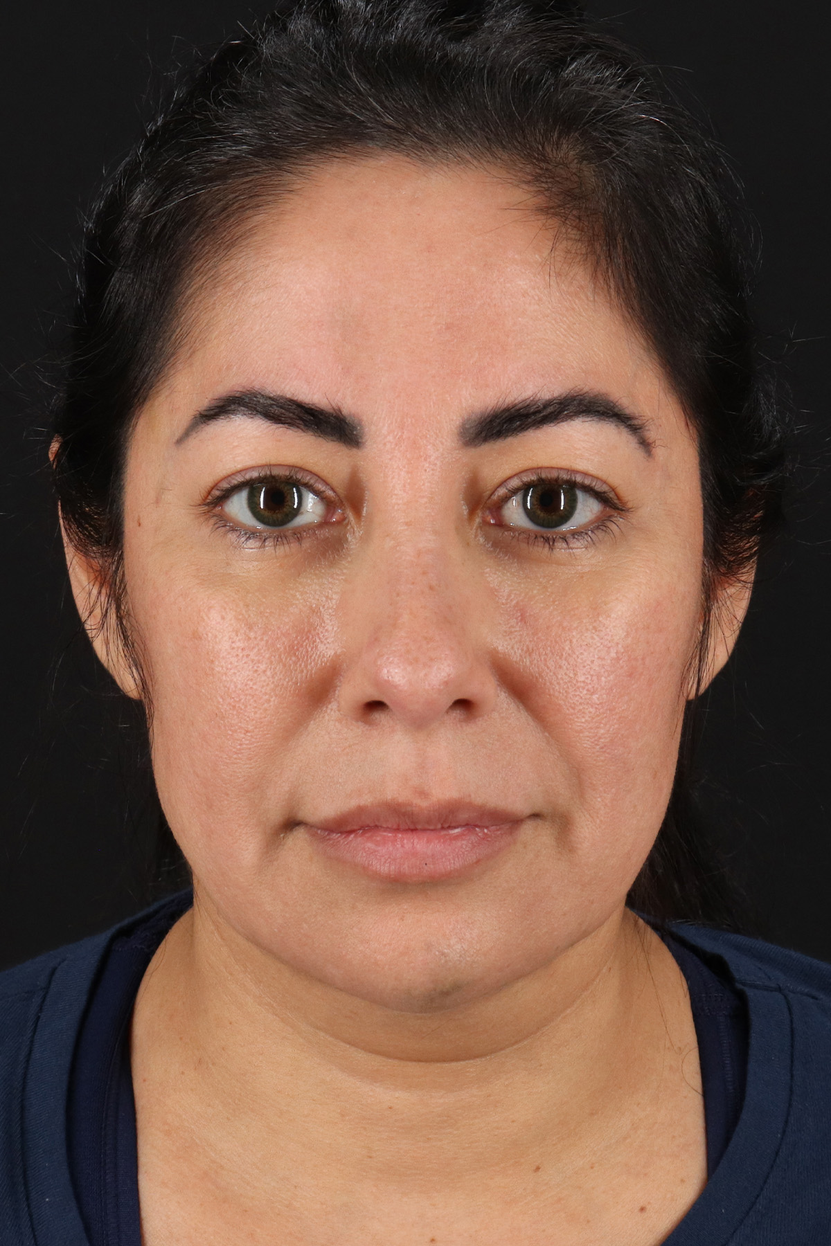 Buccal Fat Pad Before & After Patient #14014