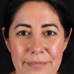 Upper Blepharoplasty Before & After Patient #12062
