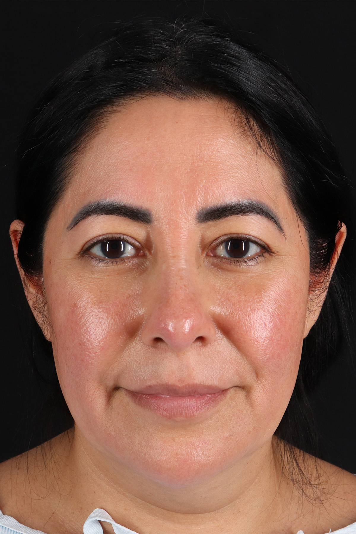 Upper Blepharoplasty Before & After Patient #12062