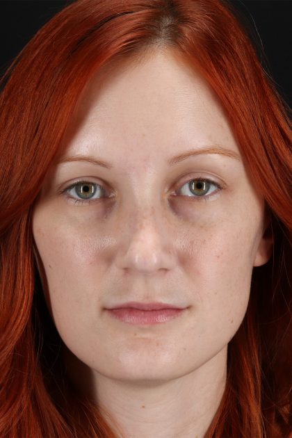 Lower Blepharoplasty Before & After Patient #13008
