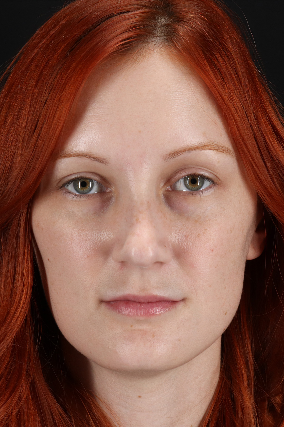 Lower Blepharoplasty Before & After Patient #13008