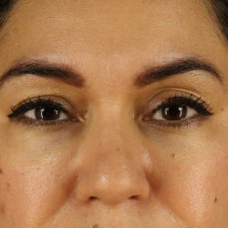 Upper Blepharoplasty Before & After Patient #12007