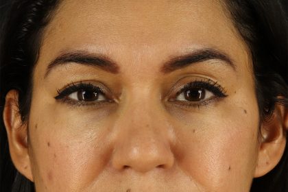 Upper Blepharoplasty Before & After Patient #12007