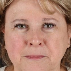 Neck Lift Before & After Patient #11696