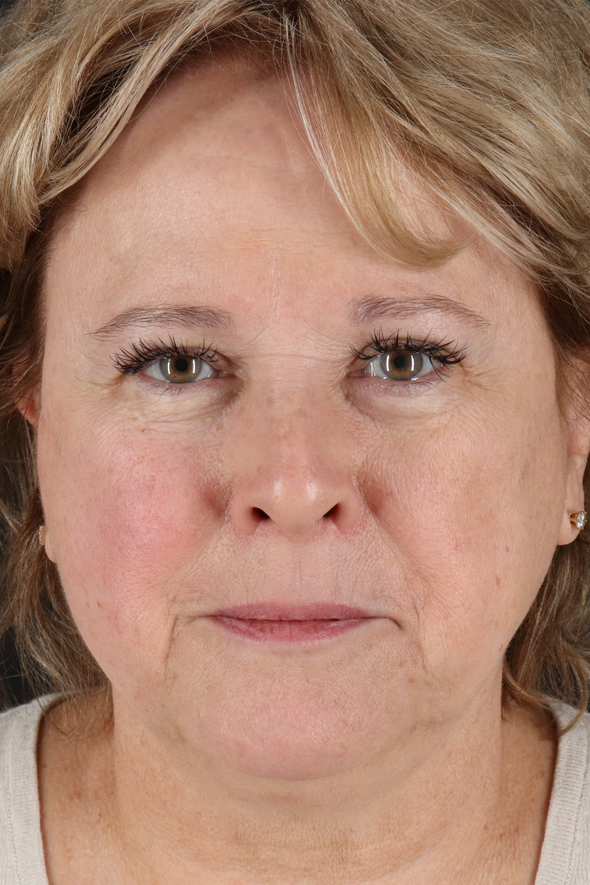 Neck Lift Before & After Patient #11696