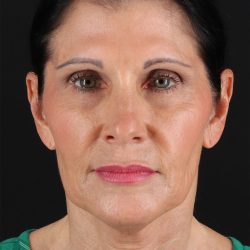 Neck Lift Before & After Patient #12887