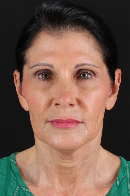 Neck Lift Before & After Patient #12887