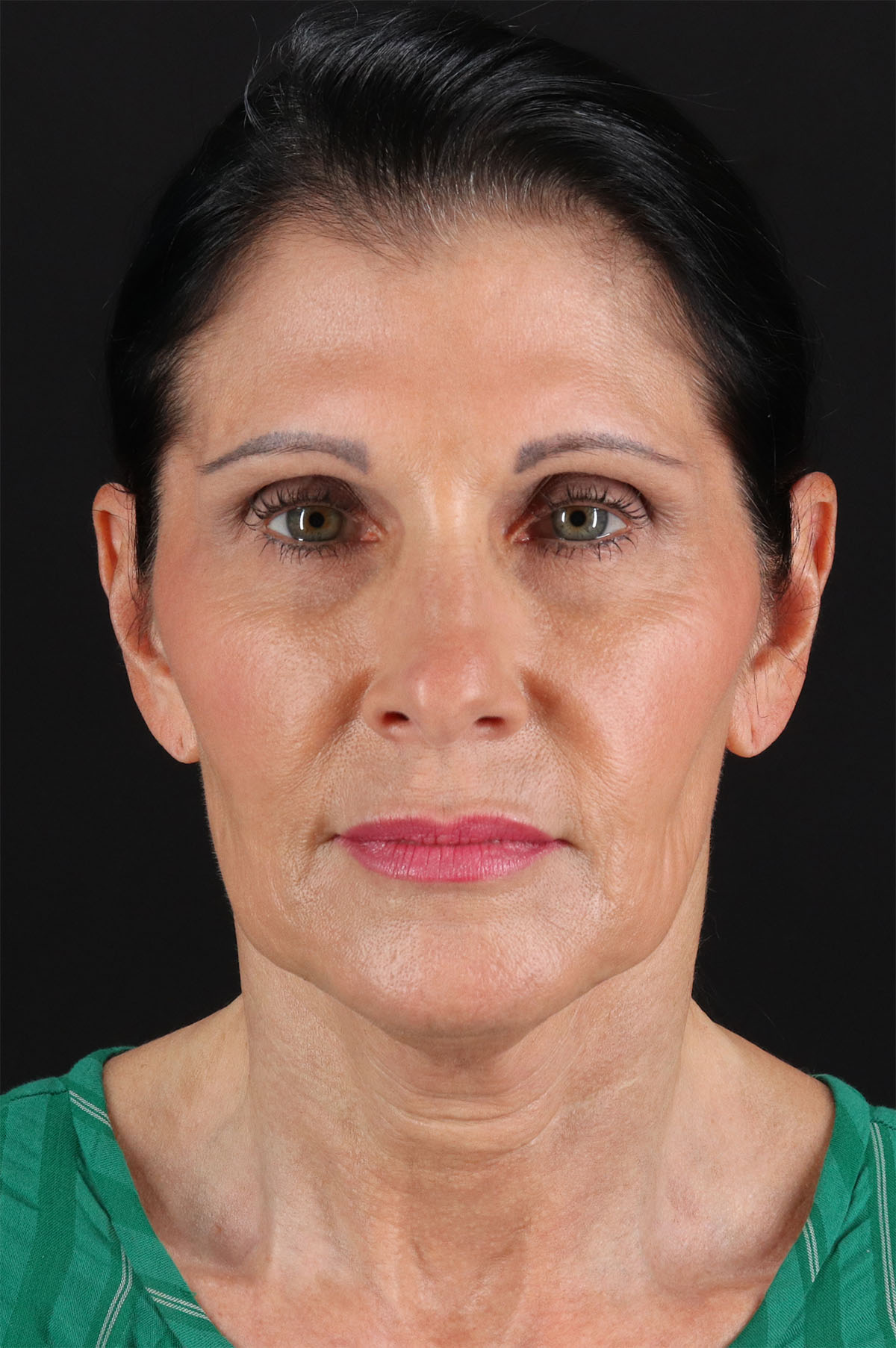 Neck Lift Before & After Patient #12887