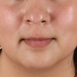 Chin Implant Before & After Patient #13794