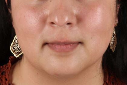 Chin Implant Before & After Patient #13794