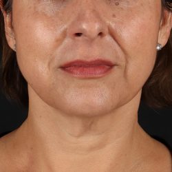 Facelift Before & After Patient #13543