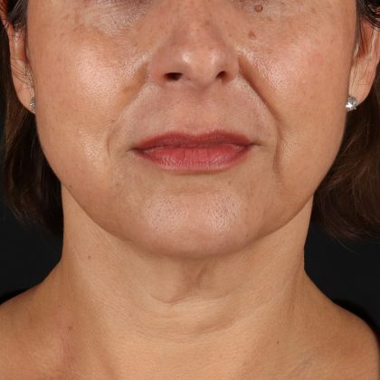 Facelift Before & After Patient #13543