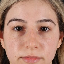 Rhinoplasty Before & After Patient #12271