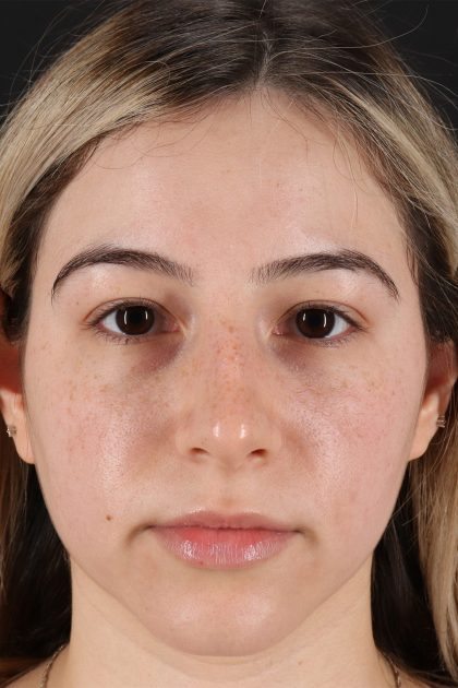 Rhinoplasty Before & After Patient #12271