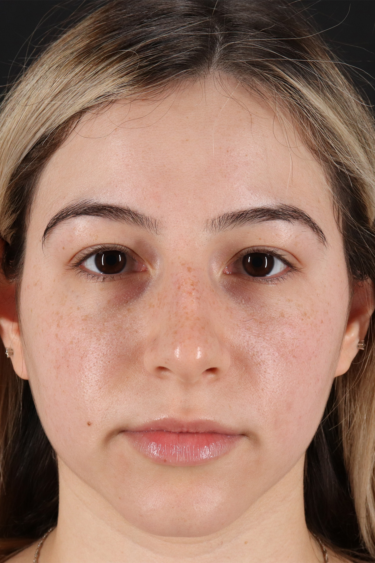 Rhinoplasty Before & After Patient #12271
