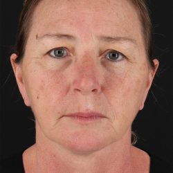 Lower Blepharoplasty Before & After Patient #13074