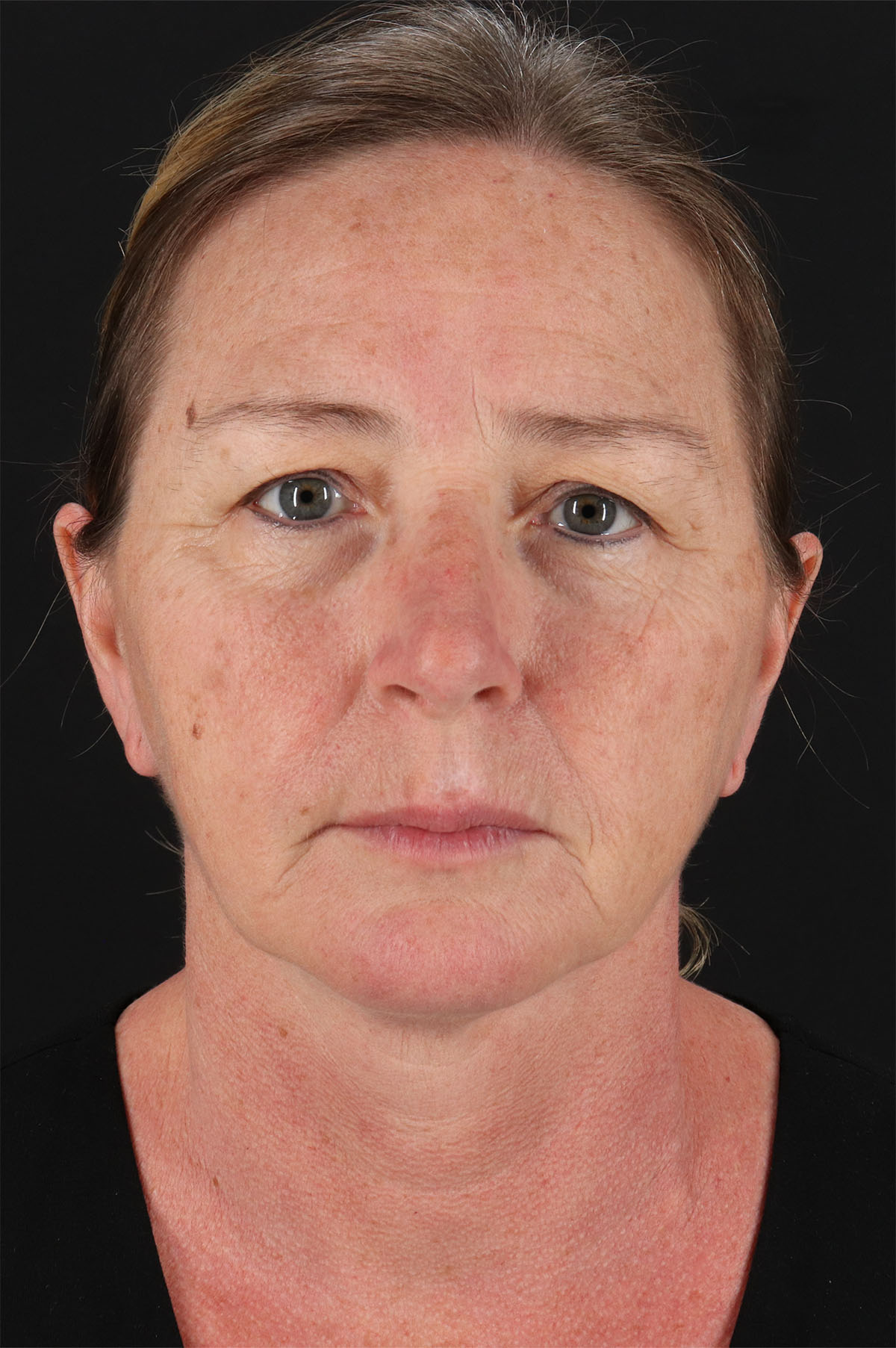 Upper Blepharoplasty Before & After Patient #12040