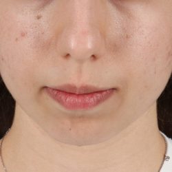 Chin Implant Before & After Patient #13772