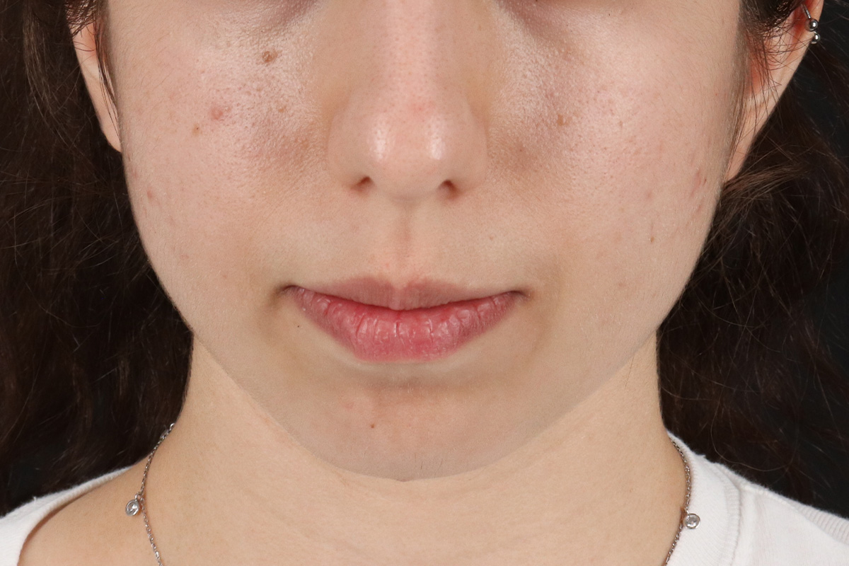Chin Implant Before & After Patient #13772