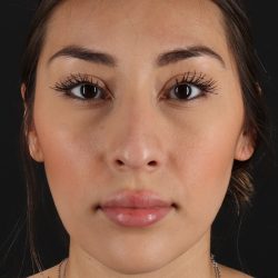 Rhinoplasty Before & After Patient #12480