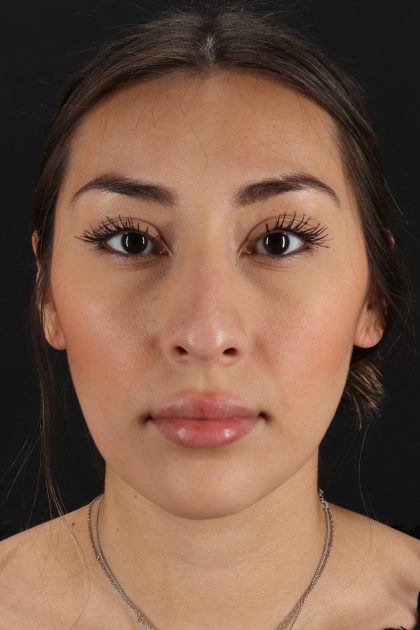 Rhinoplasty Before & After Patient #12480