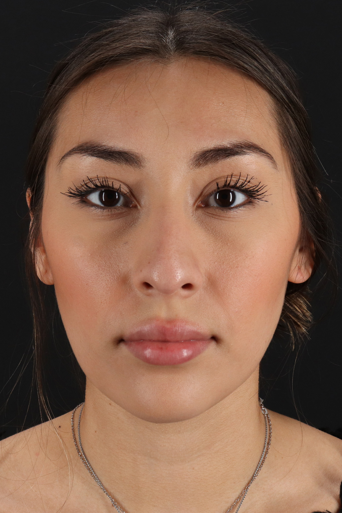 Rhinoplasty Before & After Patient #12480