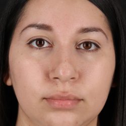 Chin Implant Before & After Patient #13739