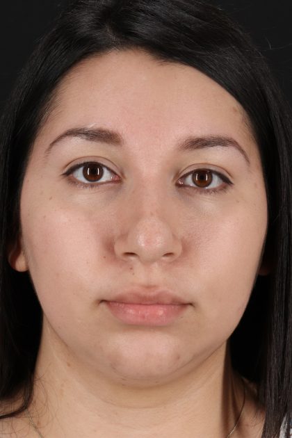 Chin Implant Before & After Patient #13739