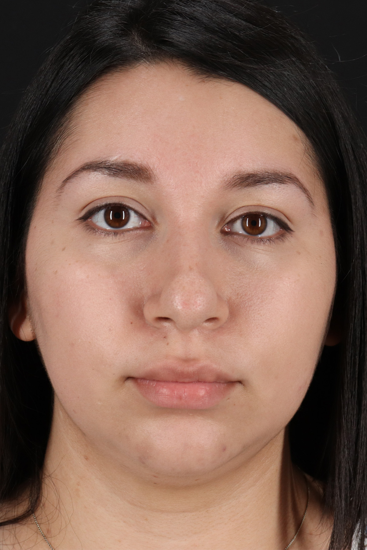 Chin Implant Before & After Patient #13739