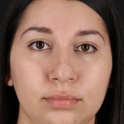Neck Lift Before & After Patient #11698