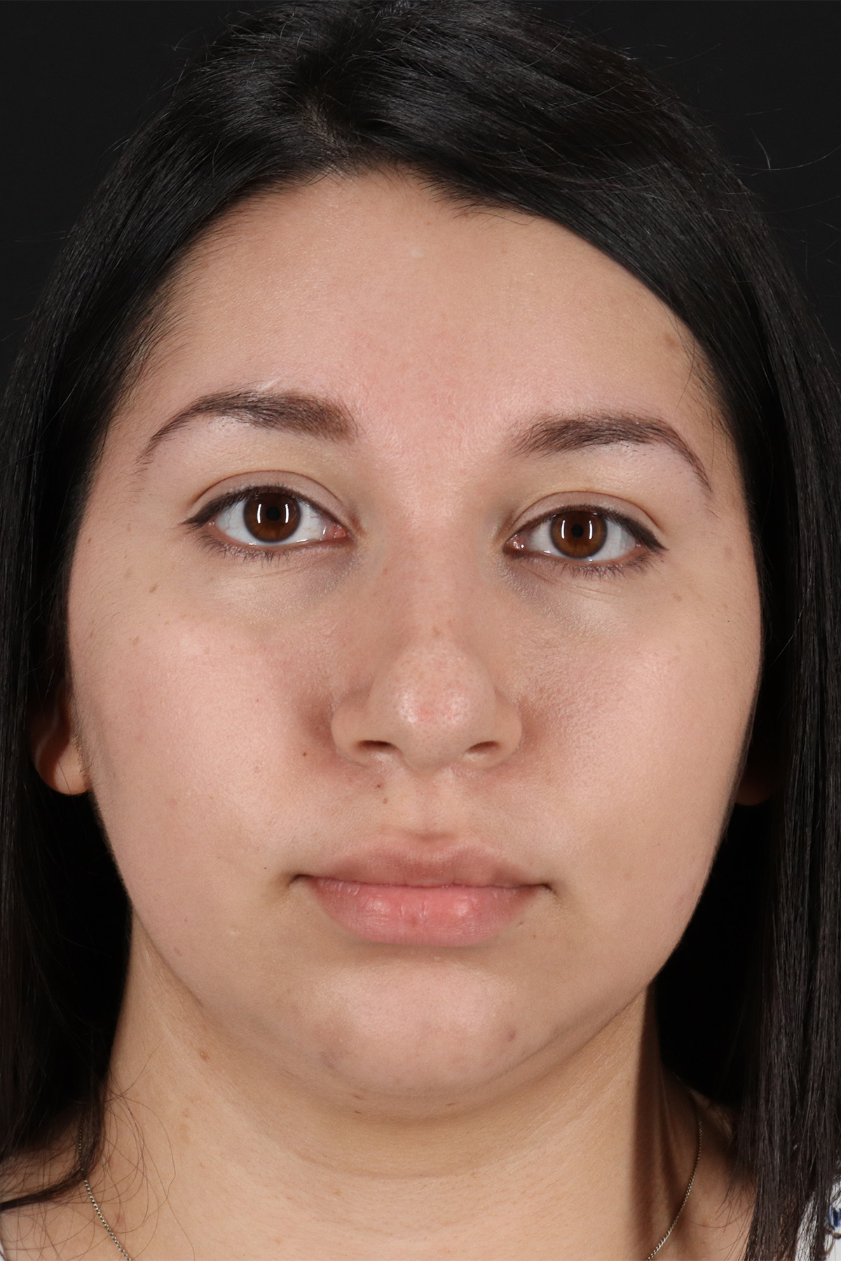 Neck Lift Before & After Patient #11698