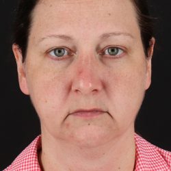 Lower Blepharoplasty Before & After Patient #13052